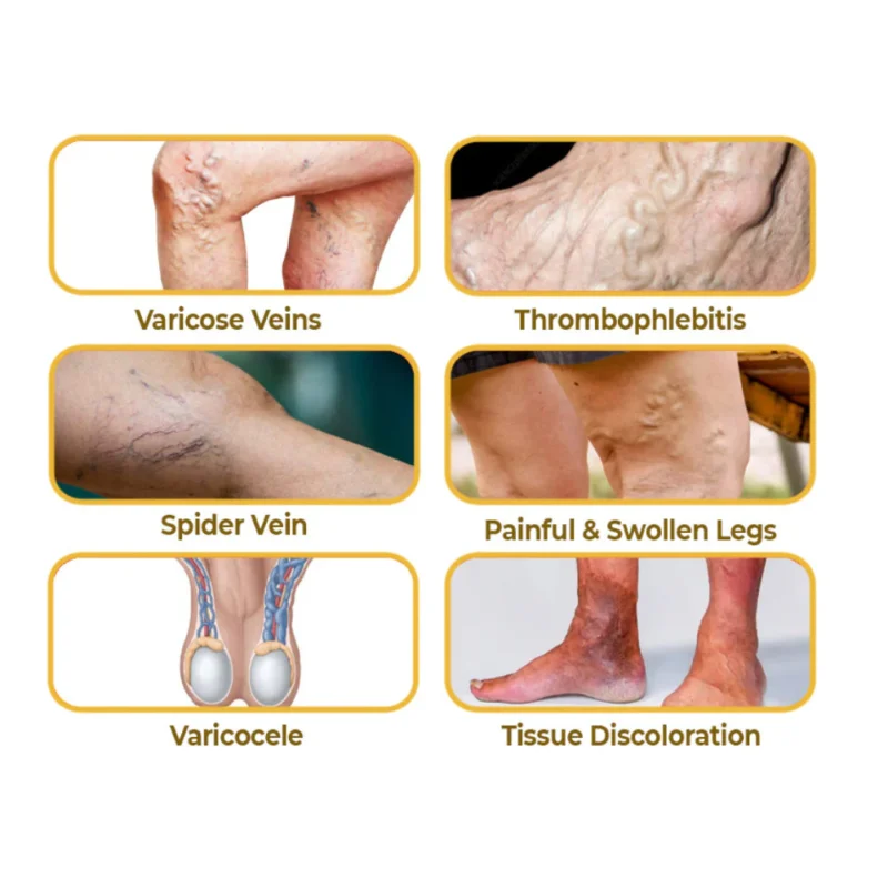 flysmus™ VaricoX Vein Dredge Bee Venom Spray