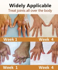 𝐓𝐎𝐃𝐀𝐇𝐎𝐅™ 𝐁𝐞𝐞 𝐕𝐞𝐧𝐨𝐦 𝐀𝐫𝐭𝐡𝐫𝐢𝐭𝐢𝐬 𝐓𝐫𝐞𝐚𝐭𝐦𝐞𝐧𝐭 𝐒𝐩𝐫𝐚𝐲