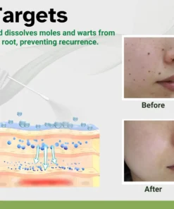 AEXZR™ Herbal Moles & Warts Removal Spray