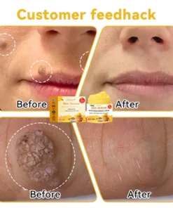 Bee Venom Wart & Moles Removal Cream