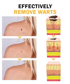 Biancat™ FlawlessFix Mole & Wart Removal Cream