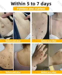 FLYCARE™ Bee Venom Mole and Wart Treatment Cream