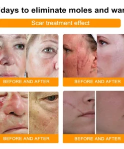 LOVILDS™ Bee Venom Wart & Tag Removal Cream