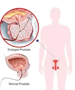 Oveallgo™ Prostate Nocturia Care Patch