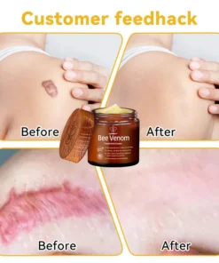 𝐁𝐞𝐞 𝐕𝐞𝐧𝐨𝐦 𝐒𝐤𝐢𝐧 𝐓𝐫𝐞𝐚𝐭𝐦𝐞𝐧𝐭 𝐂𝐫𝐞𝐚𝐦