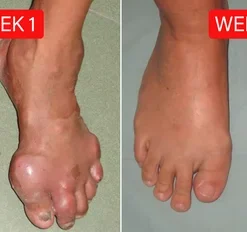 𝑭𝑨𝑻𝑶𝑵𝑮® 𝑩𝒆𝒆 𝑽𝒆𝒏𝒐𝒎 𝑷𝒂𝒊𝒏-𝑹𝒆𝒍𝒊𝒆𝒇 𝑩𝒐𝒏𝒆 𝑯𝒆𝒂𝒍𝒊𝒏𝒈 𝑪𝒓𝒆𝒂𝒎