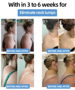 𝐌𝐫𝐞𝐒𝐢𝐨™ 𝗣𝗼𝗿𝘁𝗮𝗯𝗹𝗲 𝗟𝘆𝗺𝗽𝗵𝗮𝘁𝗶𝗰 𝗦𝗼𝗼𝘁𝗵𝗶𝗻𝗴 𝗕𝗼𝗱𝘆 𝗦𝗵𝗮𝗽𝗶𝗻𝗴 𝗨𝗹𝘁𝗿𝗮𝘀𝗼𝘂𝗻𝗱 𝗜𝗻𝘀𝘁𝗿𝘂𝗺𝗲𝗻𝘁 𝗳𝗼𝗿 𝗡𝗲𝗰𝗸