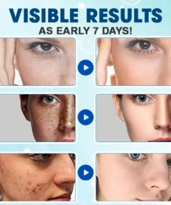 AEXZR™ Dark Spot And Acne Treatment Lotion