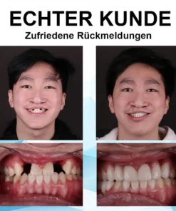 ATTDX™ Silikon Unterfütterungsset Zahnprothesen