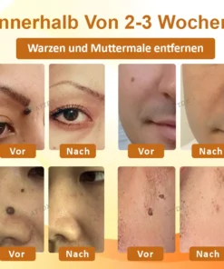 ATTDX™ Venomöse Apitherapie Tag und Muttermalentfernungspflaster