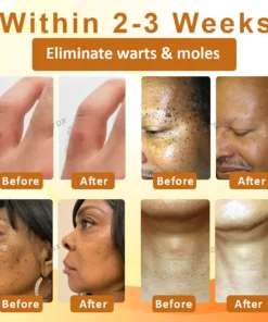 ATTDX™ Venomöse Apitherapie Tag und Muttermalentfernungspflaster