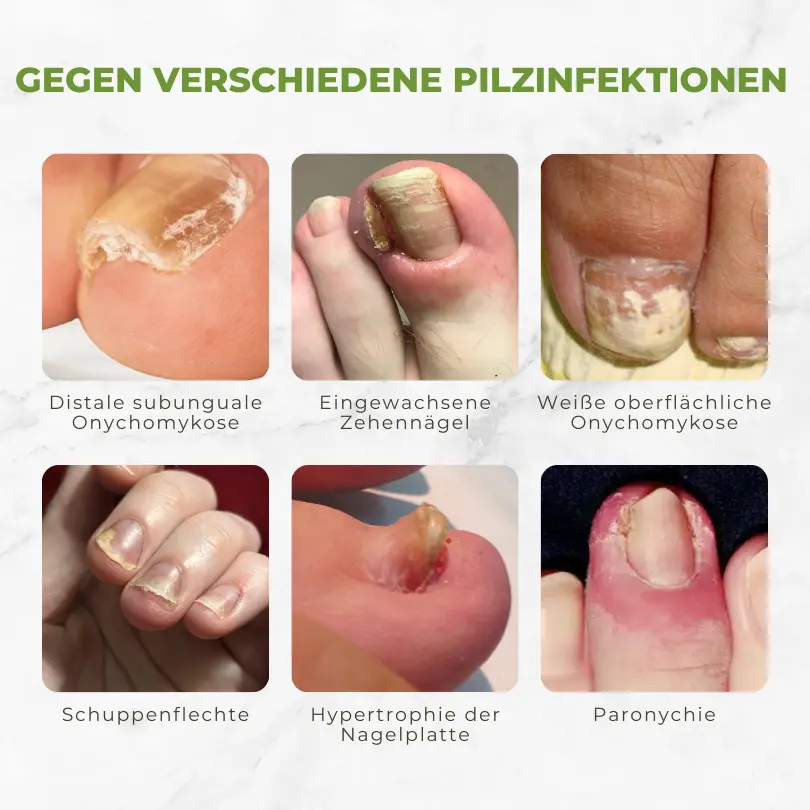 Biancat™ FungiVanish Bee Venom Nail Treatment Oil