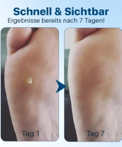 Biancat™ FußGlow Pro-Stärke Hornhaut- und Schwielenentferner-Gel