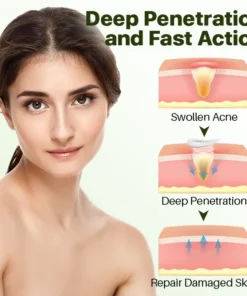 Biancat™ Herbal Acne Removal Cream