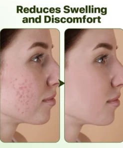 Biancat™ Herbal Acne Removal Cream