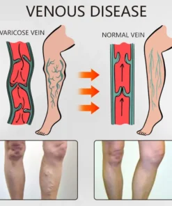 Ceoerty™ Varicose Veins Relief Oil