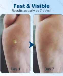 FLYCARE™ FootGlow Pro-Strength Corn & Callus Remover Gel