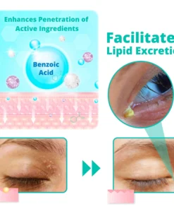 Ourlyard™ OphthlaXcare Xanthoma Treatment Vision Enhance Eye Ointment