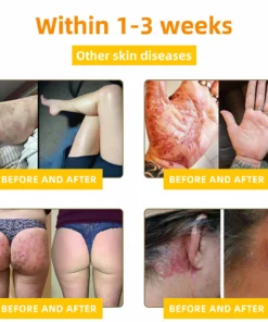 Turonu™ 𝐁𝐞𝐞 𝐕𝐞𝐧𝐨𝐦 𝐒𝐤𝐢𝐧 𝐂𝐫𝐞𝐚𝐦 - 𝐓𝐫𝐞𝐚𝐭𝐬 𝐌𝐮𝐥𝐭𝐢𝐩𝐥𝐞 𝐒𝐤𝐢𝐧 𝐂𝐨𝐧𝐝𝐢𝐭𝐢𝐨𝐧𝐬