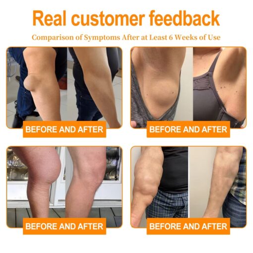 𝐂𝐫𝐨𝐚𝐢𝐞™ 𝐋𝐢𝐩𝐨𝐦𝐚 & 𝐖𝐚𝐫𝐭 𝐓𝐫𝐞𝐚𝐭𝐦𝐞𝐧𝐭 𝐂𝐫𝐞𝐚𝐦