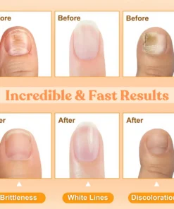 AEXZR™ Bienengift-Nagel-Reparatur-Behandlungsspray