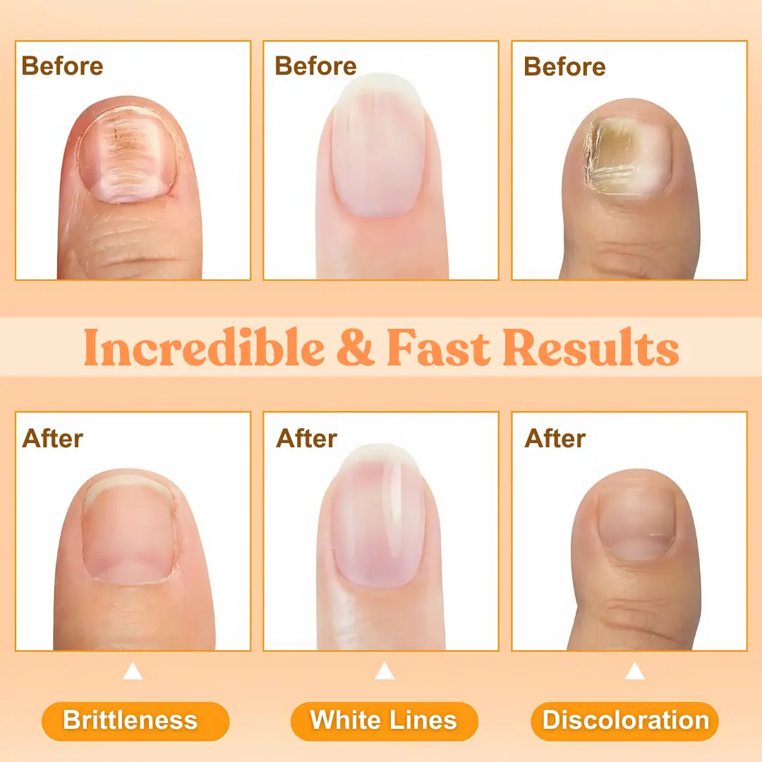 AEXZR™ Bienengift-Nagel-Reparatur-Behandlungsspray