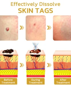 Aprolo™ Spotifly Professioneller elektrischer Beauty-Stift