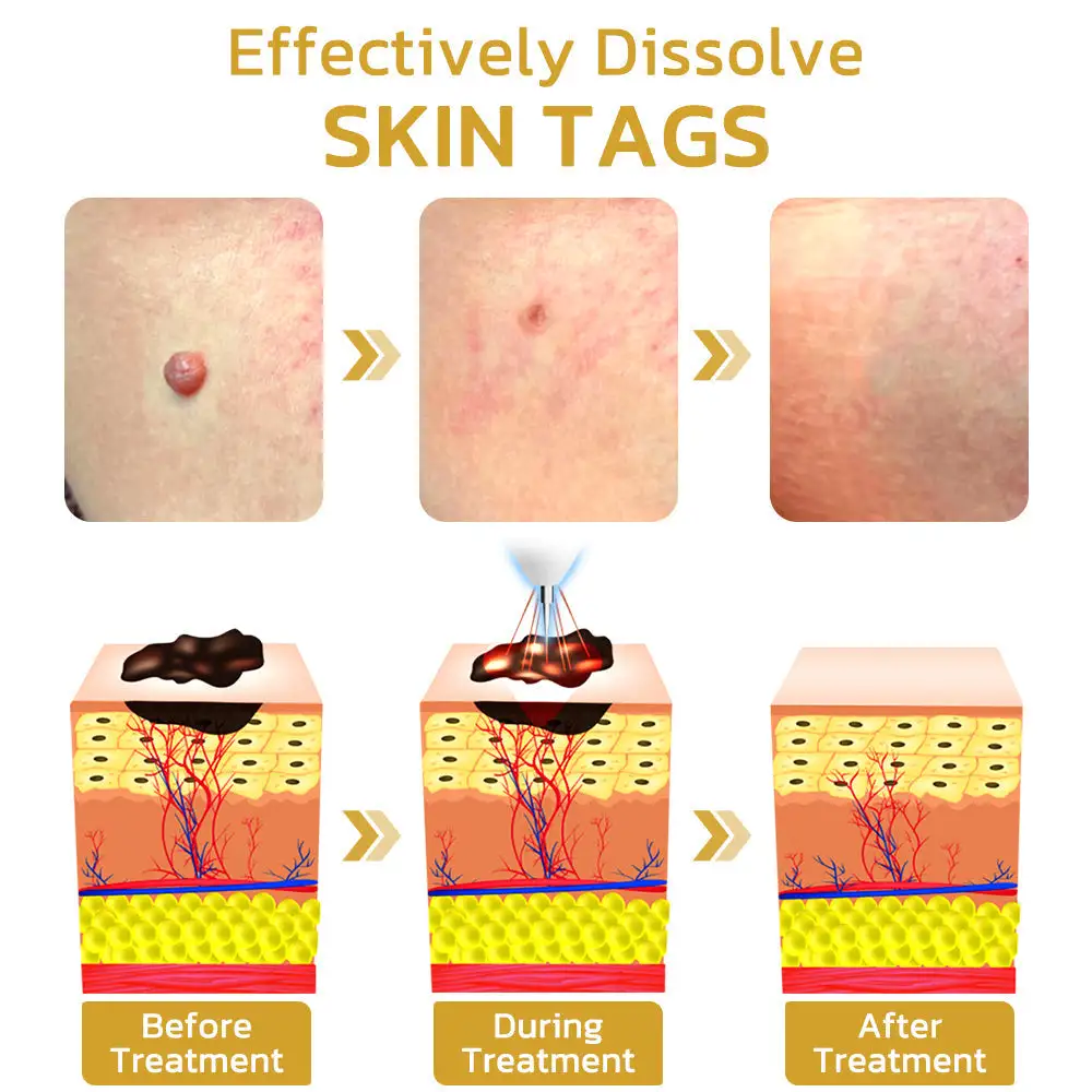 Aprolo™ Spotifly Professioneller elektrischer Beauty-Stift