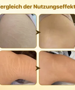 Biancat™ Dehnungsstreifen-Entfernungsöl