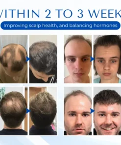 Biancat™ HairRegain Alopecia Recovery Cream