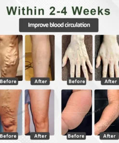 CircuWave™ Ultrasonic VascularSupport Ring