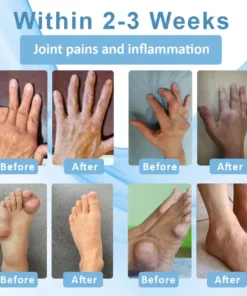 Fivfivgo™ Pflanzliches Gelenkpflaster zur Linderung von Gicht