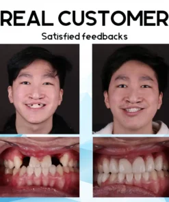 Fivfivgo™ Smart Fit Silikon Reline Prothesenset