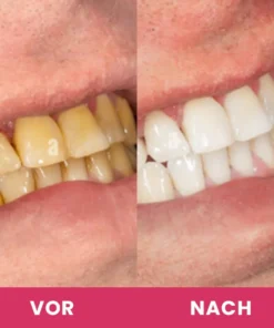 LIMETOW™ Zahnaufhellungs-Essenz-Set