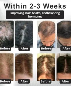 LOVILDS™ Alopecia Recovery Haar-Booster Roll-On