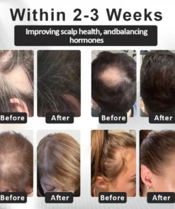 LOVILDS™ Alopecia Recovery Haar-Booster Roll-On