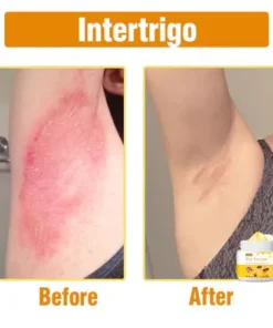 Oveallgo™ Bee Venom Comprehensive Cream