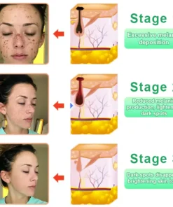 Reinigendes Peeling-Gel für Acanthosis Nigricans