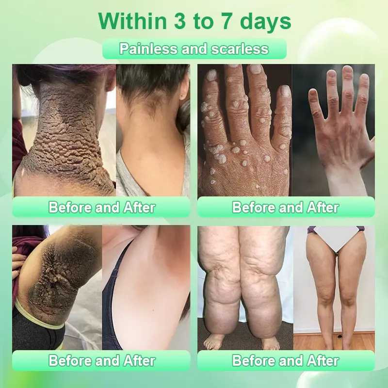 Reinigendes Peeling-Gel für Acanthosis Nigricans