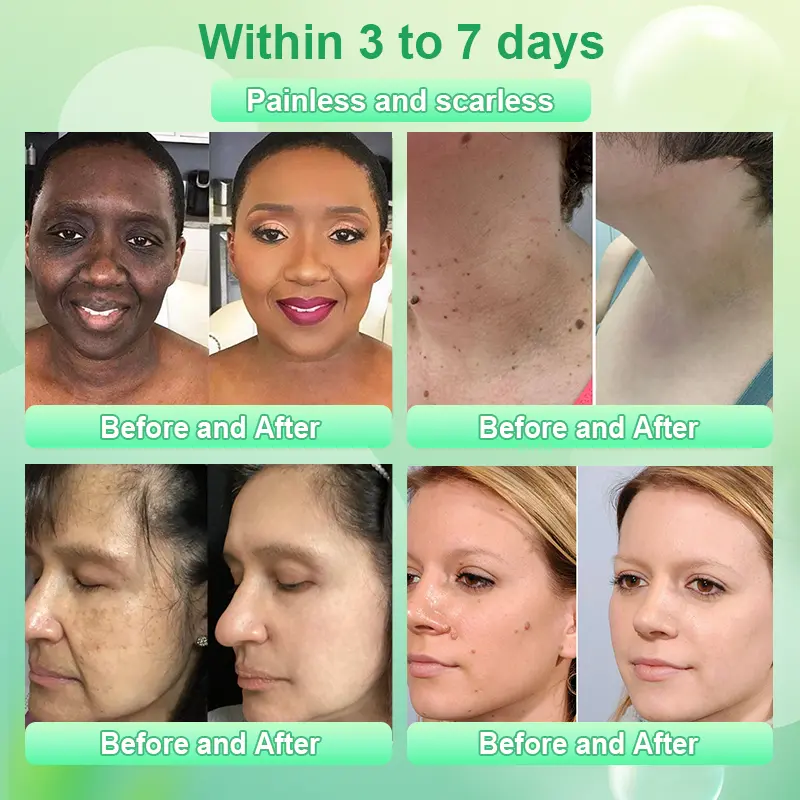 Reinigendes Peeling-Gel für Acanthosis Nigricans