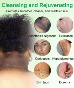 Reinigendes Peeling-Gel für Acanthosis Nigricans