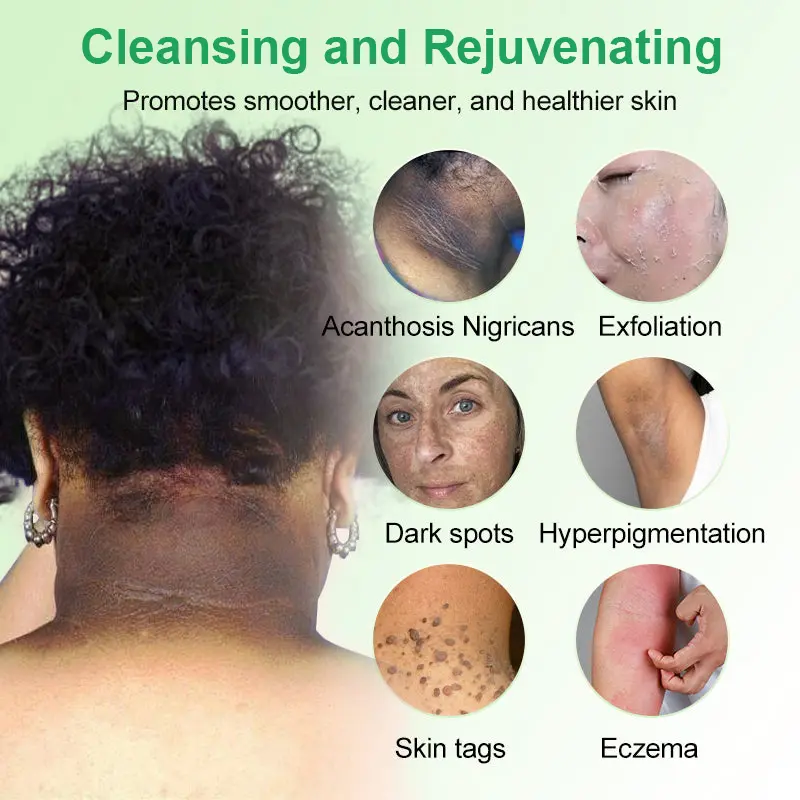 Reinigendes Peeling-Gel für Acanthosis Nigricans