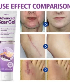 Zoencgz™ Advanced Scar Gel
