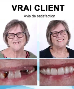 ʻO Bikenda™ Silicone Reline Denture Set