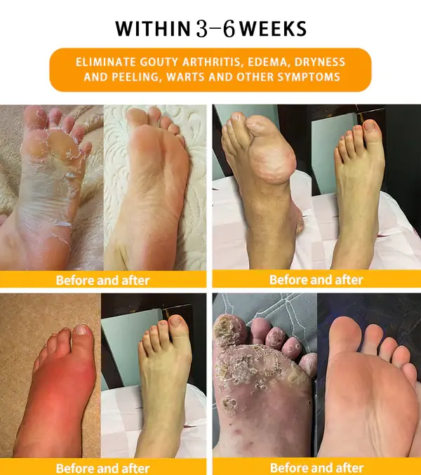 CROAIE™ Bee Venom & Herbal Slimming Foot Patches