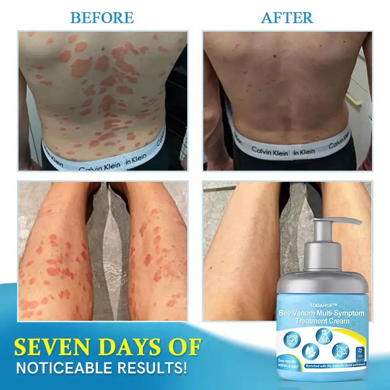 TODAHOFβ’ Bee Venom Multi-Symptom Treatment Cream