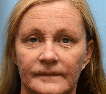 Furzero™ Botox Bee Venom Wrinkle Removal Cream - Image 10