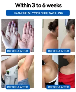 𝐂𝐙𝐓𝐈𝐂𝐋𝐄™ 𝐔𝐥𝐭𝐫𝐚𝐬𝐨𝐧𝐢𝐜 𝐅𝐚𝐭 𝐋𝐨𝐬𝐬 & 𝐈𝐧𝐟𝐫𝐚𝐫𝐞𝐝 𝐁𝐥𝐨𝐨𝐝 𝐒𝐮𝐠𝐚𝐫 𝐁𝐚𝐥𝐚𝐧𝐜𝐢𝐧𝐠 𝐋𝐲𝐦𝐩𝐡𝐚𝐭𝐢𝐜 𝐃𝐫𝐚𝐢𝐧𝐚𝐠𝐞 𝐖𝐫𝐢𝐬𝐭𝐛𝐚𝐧𝐝☄️☄️ (𝐏𝐚𝐢𝐧𝐥𝐞𝐬𝐬, 𝐋𝐨𝐧𝐠 𝐋𝐚𝐬𝐭𝐢𝐧𝐠, 𝐓𝐫𝐞𝐚𝐭𝐦𝐞𝐧𝐭 𝐟𝐨𝐫 𝐃𝐢𝐚𝐛𝐞𝐭𝐞𝐬, 𝐎𝐛𝐞𝐬𝐢𝐭𝐲 𝐚𝐧𝐝 𝐋𝐲𝐦𝐩𝐡𝐚𝐭𝐢𝐜 𝐃𝐫𝐚𝐢𝐧𝐚𝐠𝐞)