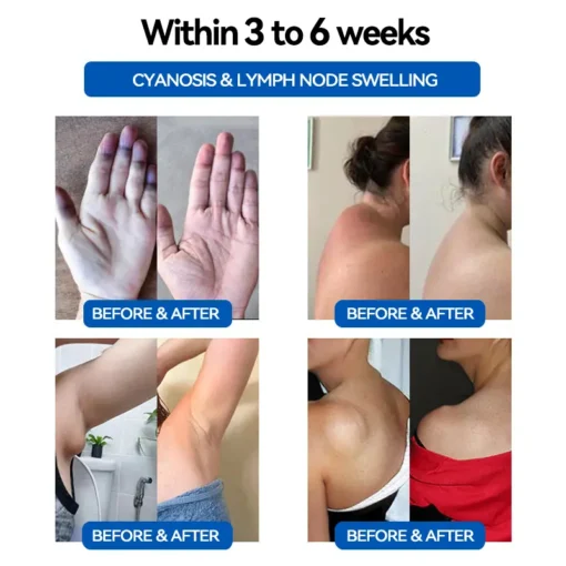 𝐂𝐙𝐓𝐈𝐂𝐋𝐄™ 𝐔𝐥𝐭𝐫𝐚𝐬𝐨𝐧𝐢𝐜 𝐅𝐚𝐭 𝐋𝐨𝐬𝐬 & 𝐈𝐧𝐟𝐫𝐚𝐫𝐞𝐝 𝐁𝐥𝐨𝐨𝐝 𝐒𝐮𝐠𝐚𝐫 𝐁𝐚𝐥𝐚𝐧𝐜𝐢𝐧𝐠 𝐋𝐲𝐦𝐩𝐡𝐚𝐭𝐢𝐜 𝐃𝐫𝐚𝐢𝐧𝐚𝐠𝐞 𝐖𝐫𝐢𝐬𝐭𝐛𝐚𝐧𝐝☄️☄️ (𝐏𝐚𝐢𝐧𝐥𝐞𝐬𝐬, 𝐋𝐨𝐧𝐠 𝐋𝐚𝐬𝐭𝐢𝐧𝐠, 𝐓𝐫𝐞𝐚𝐭𝐦𝐞𝐧𝐭 𝐟𝐨𝐫 𝐃𝐢𝐚𝐛𝐞𝐭𝐞𝐬, 𝐎𝐛𝐞𝐬𝐢𝐭𝐲 𝐚𝐧𝐝 𝐋𝐲𝐦𝐩𝐡𝐚𝐭𝐢𝐜 𝐃𝐫𝐚𝐢𝐧𝐚𝐠𝐞)