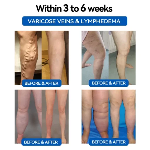 𝐂𝐙𝐓𝐈𝐂𝐋𝐄™ 𝐔𝐥𝐭𝐫𝐚𝐬𝐨𝐧𝐢𝐜 𝐅𝐚𝐭 𝐋𝐨𝐬𝐬 & 𝐈𝐧𝐟𝐫𝐚𝐫𝐞𝐝 𝐁𝐥𝐨𝐨𝐝 𝐒𝐮𝐠𝐚𝐫 𝐁𝐚𝐥𝐚𝐧𝐜𝐢𝐧𝐠 𝐋𝐲𝐦𝐩𝐡𝐚𝐭𝐢𝐜 𝐃𝐫𝐚𝐢𝐧𝐚𝐠𝐞 𝐖𝐫𝐢𝐬𝐭𝐛𝐚𝐧𝐝☄️☄️ (𝐏𝐚𝐢𝐧𝐥𝐞𝐬𝐬, 𝐋𝐨𝐧𝐠 𝐋𝐚𝐬𝐭𝐢𝐧𝐠, 𝐓𝐫𝐞𝐚𝐭𝐦𝐞𝐧𝐭 𝐟𝐨𝐫 𝐃𝐢𝐚𝐛𝐞𝐭𝐞𝐬, 𝐎𝐛𝐞𝐬𝐢𝐭𝐲 𝐚𝐧𝐝 𝐋𝐲𝐦𝐩𝐡𝐚𝐭𝐢𝐜 𝐃𝐫𝐚𝐢𝐧𝐚𝐠𝐞)
